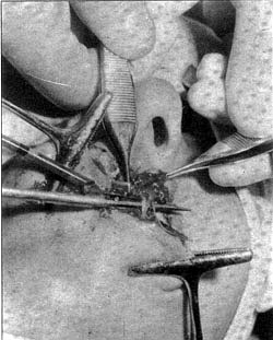 Fig. 3Trazado el colgajo de¡ labio inferior se muestra el pedículo vascular sobre el que se basa.<br><b>Fig.3</b> Tracing of the lower lip flap. The vascular pedicle on which it is based is shown.