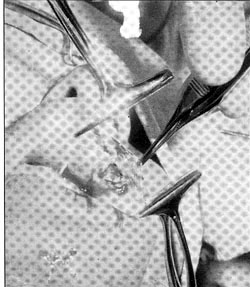 Fig. 4Resecada la zona cicatricial en el labio superior, se diseca el horde mucoso superior para luego suiurarlo al labio inferior.<br><b>Fig.4</b> Once the scar zone in the upper lip is resec ted, the upper mucosal border is dissected to suture it afterwards to the lower lip.