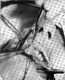 Fig. 5Mostrando la forma del colgajo en << Fleur de Lis >> tornado del labio inferior. Nótese como la porción central es la más voluminosa.<br><b>Fig.5</b> Shows the shape of the << Fleur de Lis >> flaps, taken from the lower lip. Notice that the central portion is the most bulky.