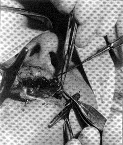 Fig. 6La hoja izquierda del colgajo se sutura por detrás y afuera del horde labial superior.<br><b>Fig.6</b> The left leaf is sutured behind and outward of the upper labial border.