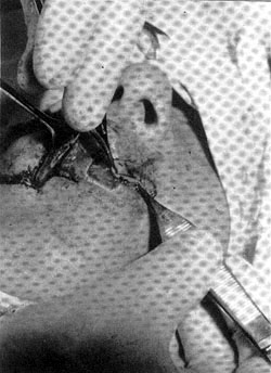 Fig. 7Ya suturado el colgajo al labio superior, se recanstruye labio inferior suturando los tios extremos del músculo y deslizanda la mucosa para suturarla directamente al otro extremo.<br><b>Fig.7</b> Once the flap is sutured to the upper lip, the lower lip is reconstructed suturing both muscle ends and sliding the mucosa to suture it directly to the other end.