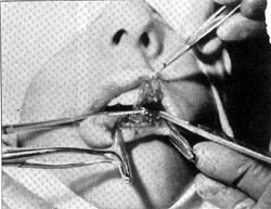 Fig. 9Secci�n del ped�culo del colgajo y normalizaci�n de] mismo. Se reconstruye horde cut�neo-mucoso del labio inferior.<br><b>Fig.9</b> The pedicle is severed and the flap normalized. The skinnwcosal border of the lower lip is reconstructed.