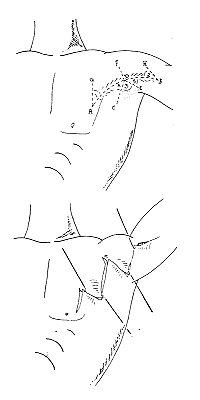 Fig (1): Five-flap Y-V advancement and Z-plasty.