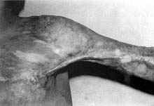 Fig. (2 - A): Postburn scar contracture of left anterior axillary fold in a male patient aged 8 years (Type I) reconstructed by five-flaps. Preoperative