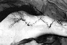 Fig. (2- B): Postburn scar contracture of left anterior axillary fold in a male patient aged 8 years (Type I) reconstructed by five-flaps. Post operative view