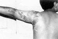 Fig. (3-A): Postburn scar contracture of the left posterior axillary fold in a male patient aged 8 years (Type II) reconstructed by lateral thoracic pedicled fasciocutaneous flap.Preoperative