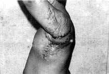 Fig. (3-B): Postburn scar contracture of the left posterior axillary fold in a male patient aged 8 years (Type II) reconstructed by lateral thoracic pedicled fasciocutaneous flap.Postoperative.