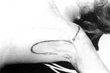 Fig. (4-A): Postburn scar contracture of the left anterior axillary fold in a female patient aged 4.5 years (Type II) reconstructed by lateral thoracic pedicled fasciocutaneous flap.Preoperative