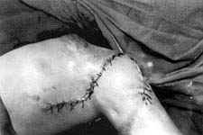 Fig. (4-B): Postburn scar contracture of the left anterior axillary fold in a female patient aged 4.5 years (Type II) reconstructed by lateral thoracic pedicled fasciocutaneous flap.Postoperative.
