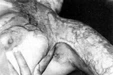 Fig. (5-A): Postburn scar contracture of the left anterior axillary fold in a female patient aged 20 years (Type II) reconstructed by inner arm pedicled fasciocutancous flap.Preoperative b) Postoperative.