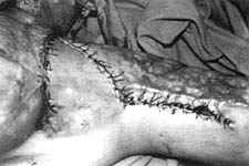 Fig. (5-B): Postburn scar contracture of the left anterior axillary fold in a female patient aged 20 years (Type II) reconstructed by inner arm pedicled fasciocutancous flap.Postoperative.