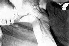 Fig. (6-A): Postburn scar contracture of the left anterior axillary fold in a female patient aged 22 years (Type II) reconstructed by inner arm pedicled fasciocutancous flap.Preoperative.