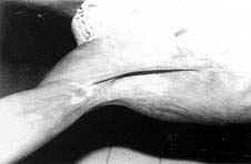 Fig. (7-A): Postburn scar contracture of the right axilla (Type IV) in a male patient aged 20 years reconstructed by parascapular island fasciocutancous flap.Preoperative.