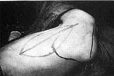 Fig. (7-B): Postburn scar contracture of the right axilla (Type IV) in a male patient aged 20 years reconstructed by parascapular island fasciocutancous flap.Flap design.