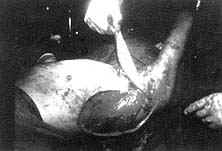 Fig. (7-C): Postburn scar contracture of the right axilla (Type IV) in a male patient aged 20 years reconstructed by parascapular island fasciocutancous flap.Flap elevation.