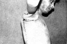 Fig. (7-E): Postburn scar contracture of the right axilla (Type IV) in a male patient aged 20 years reconstructed by parascapular island fasciocutancous flap.Ten days postoperative.