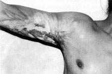 Fig. (8-A): Postburn scar contracture of the right axilla (Type IV) in a female patient aged 15 years reconstructed by parascapular island fasciocutaneous flap.Preoperative 