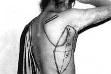 Fig. (8-B): Postburn scar contracture of the right axilla (Type IV) in a female patient aged 15 years reconstructed by parascapular island fasciocutaneous flap.Flap design