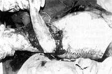 Fig. (8-C): Postburn scar contracture of the right axilla (Type IV) in a female patient aged 15 years reconstructed by parascapular island fasciocutaneous flap.Flap elevation.