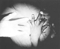 Fig. (4,A): Preoperative, dorsal view.
