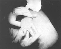 Fig. (4,B): Preoperative, volar view.