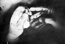 Fig. (4,C): Dorsal flap with lateral 