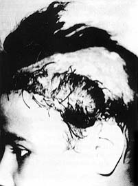 Fig(6): a-Pre and b- Post operative photographs of case No. 13
