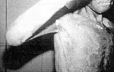 Fig. (2-A): Preoperative severe post burn axillary contracture