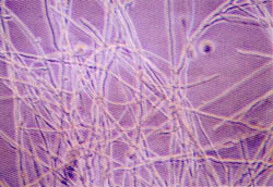Fig. (1-B): Fungal contamination of keratinocyte culture. Inverted phase micrograph magnified 100 X.