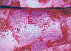 Fig. (2-A) :Cultured allogenic keratinocyte gafts applied onto meshed skin autograft.