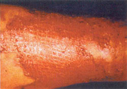 Fig. (2-B): The same case showing complete closure of the interstices of the meshed autograft by the 5th postoperative day. 