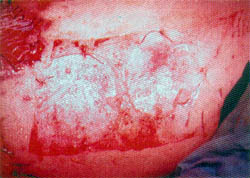 Fig. (3-A) Split-thickness skin gaft donor site covered by cultured allogenic keratinocyte grafts, intraoperative view