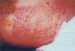 Fig. (3-B): The same donor site, 7 days postoperatively. See delayed healing of the periphery in aereas not covered by cultured allograft.