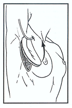 Fig. (2): A diagram showing the design of lateral thoracic flap.