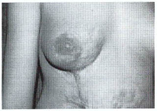 Fig. (3A): A case of V-Y plasty (pre and post). 