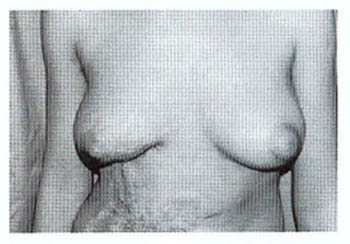 Fig. (3B): A case of V-Y plasty (pre and post). 