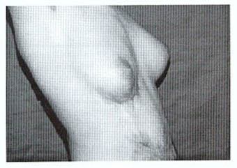 Fig. (4A): A case of Z-plasty (pre and post) 