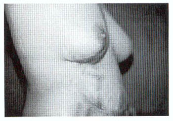 Fig. (4B): A case of Z-plasty (pre and post)