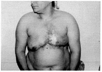 Fig. (5, A): A case of thoracoepigastric flap (pre and post). 