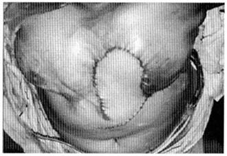 Fig. (5,B): A case of thoracoepigastric flap (pre and post).