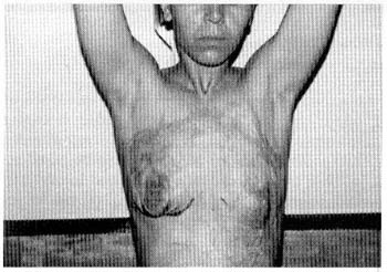 Fig. (6A): A case of sliding abdominal flap (pre and post). 