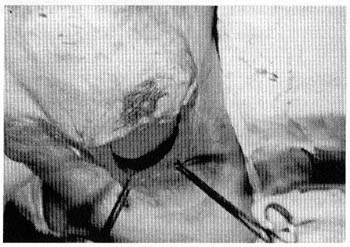 Fig. (6B): A case of sliding abdominal flap (pre and post). 