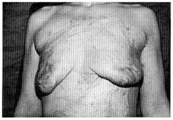 Fig. (6C): A case of sliding abdominal flap (pre and post).