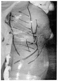 Fig. (7A): A case of lateral thoracic flap (pre and post). 