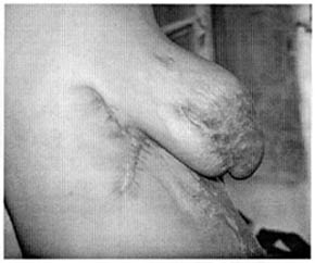 Fig. (7B): A case of lateral thoracic flap (pre and post).