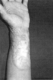 Fig. (1): Post burn scarring of the left forearm with depigmentation and surface irregurality