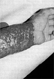 Fig. (2): Dermaabrasion of the scar tissue