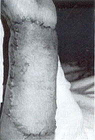 Fig. (3): Application of the skin graft to the raw surface after dermabrasion.