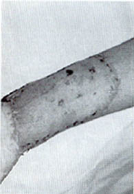 Fig. (4): One week later with excellent take of the skin graft.