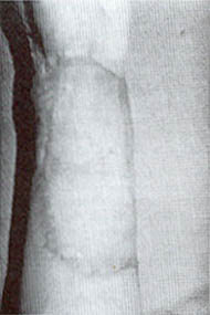 Fig. (5): Late post operative (6 month) appearence of the skin graft with excellent color matching.
